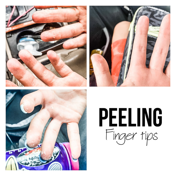 Peeling Fingertips?